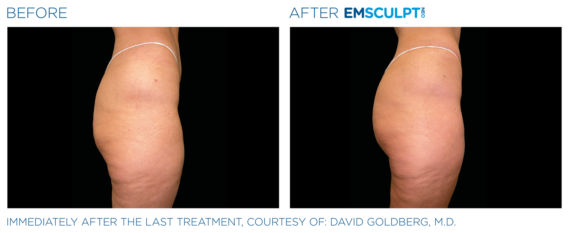 Before-and-after side view of a torso, labeled “Before” and “After Emsculpt,” showing reduced abdomen