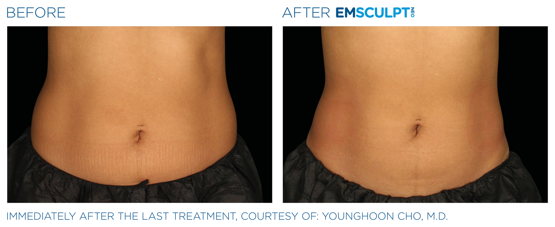 A before and after picture of a woman 's stomach