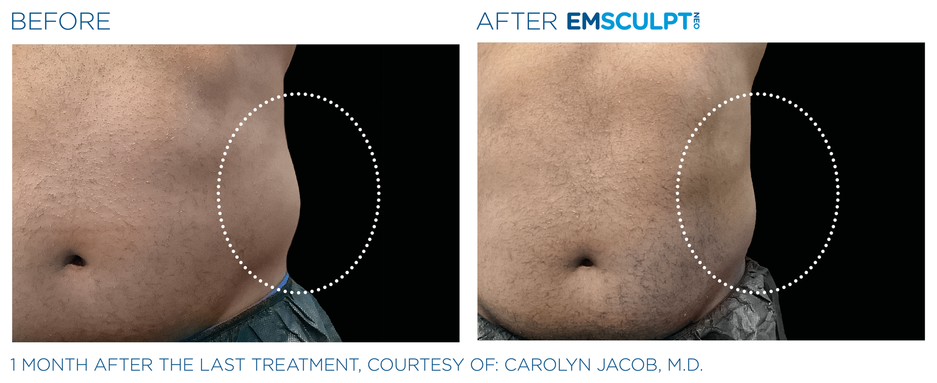 A before and after picture of a man 's stomach.
