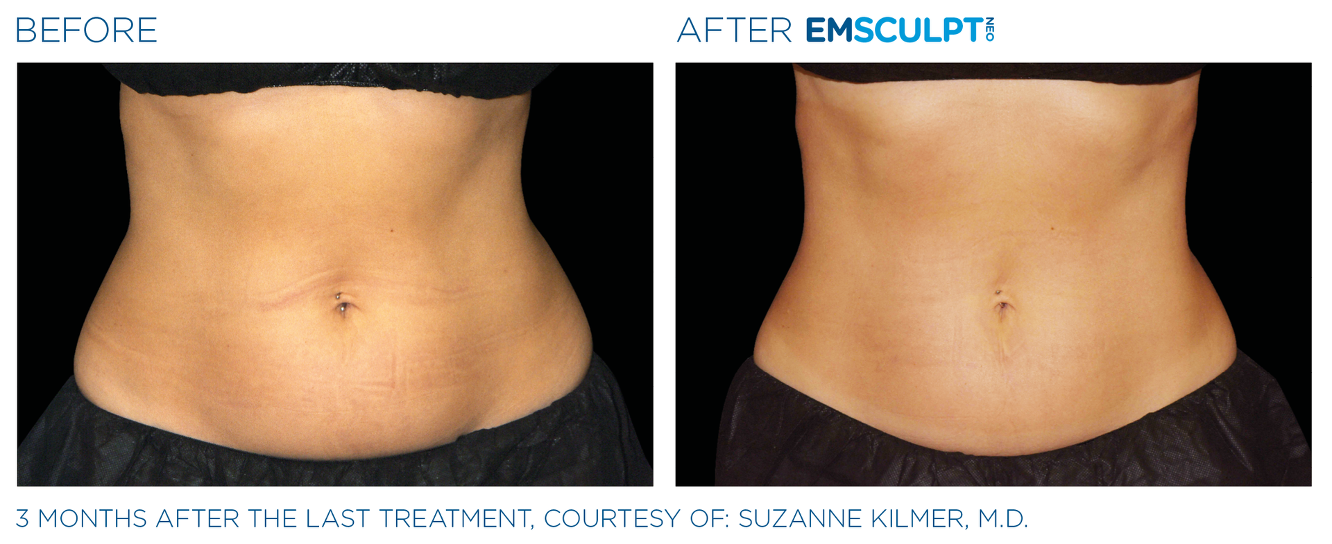 A before and after picture of a woman 's stomach.