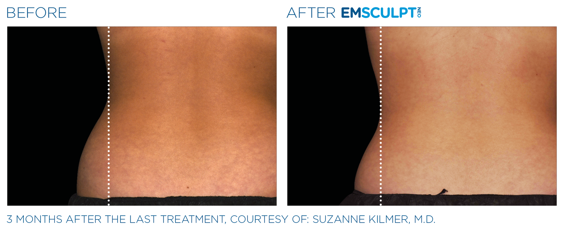 A before and after picture of a woman 's back