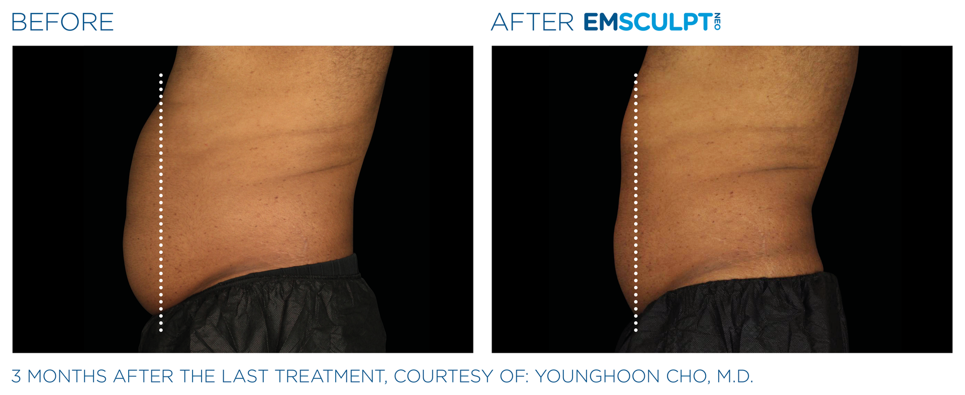 A before and after picture of a man 's stomach