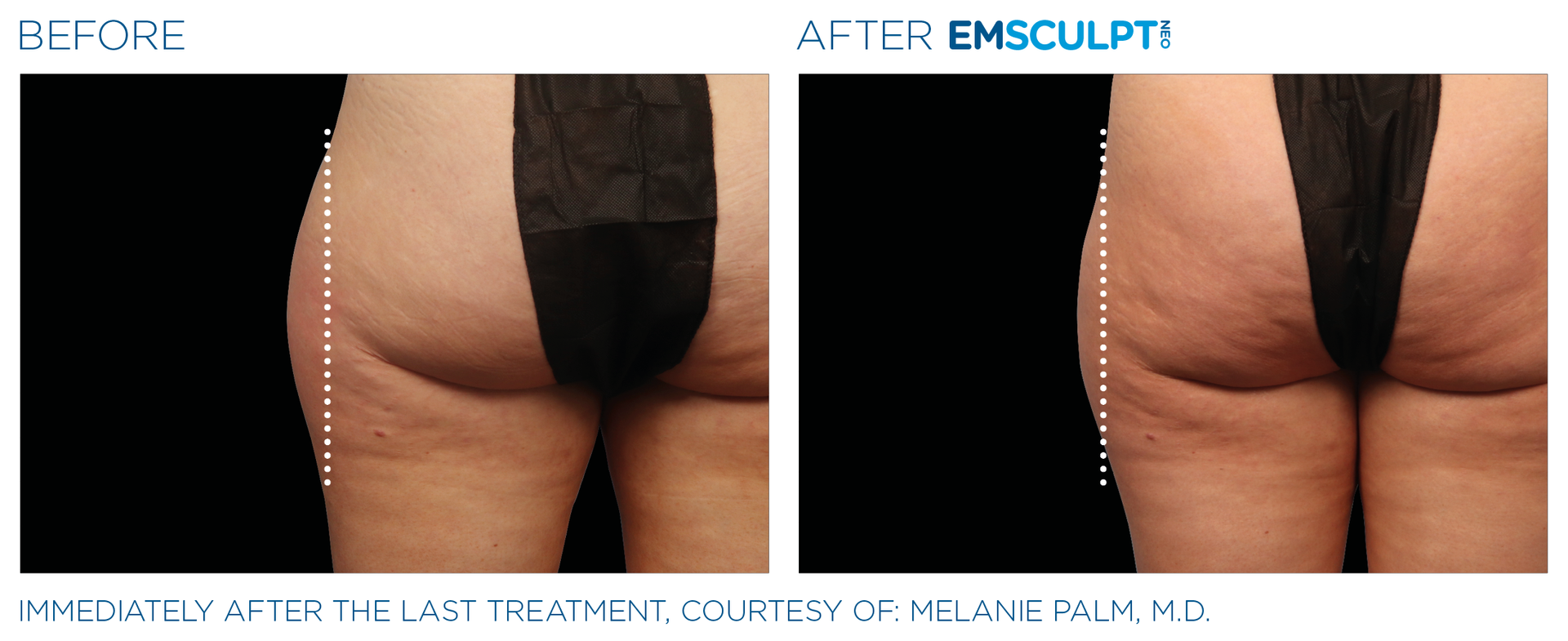 Before-and-after side view of a torso showing reduced waist and back fat after treatment