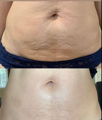 A before and after picture of a woman 's stomach.