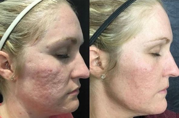 A before and after photo of a woman 's face with acne.