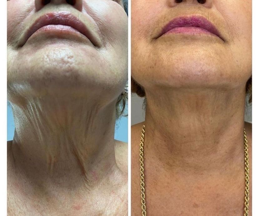A before and after photo of a woman 's neck and face.