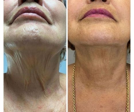 A before and after photo of a woman 's neck and face.