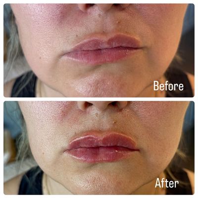 A before and after picture of a woman 's lips.