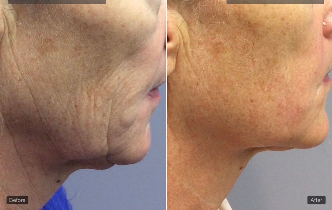 A before and after photo of a woman 's face and neck.