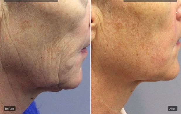 A before and after photo of a woman 's face and neck.