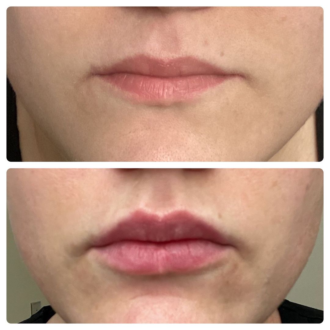 A before and after photo of a woman 's lips.