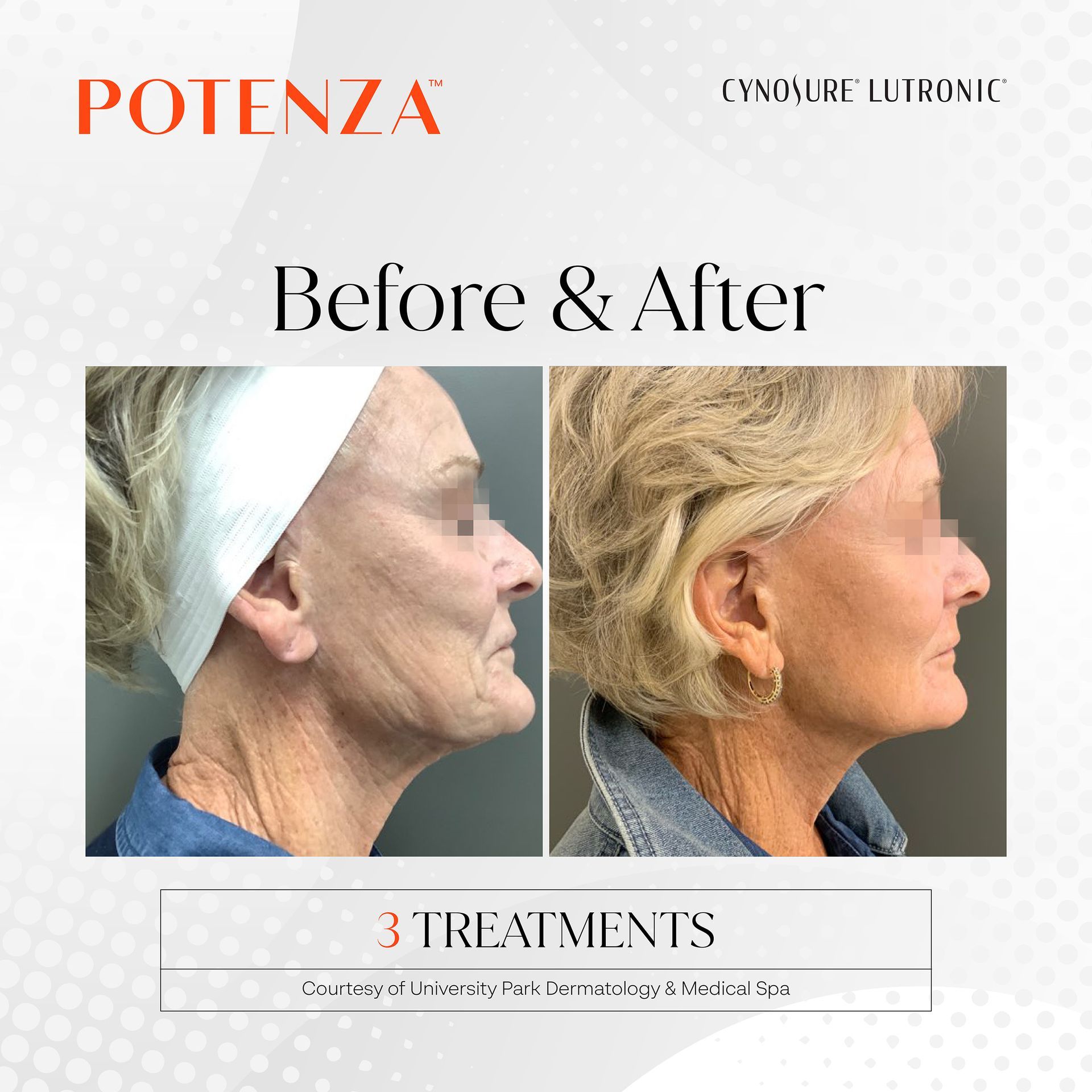 Before-and-after side profile photos of a face treatment, with branding and “3 treatments” text.