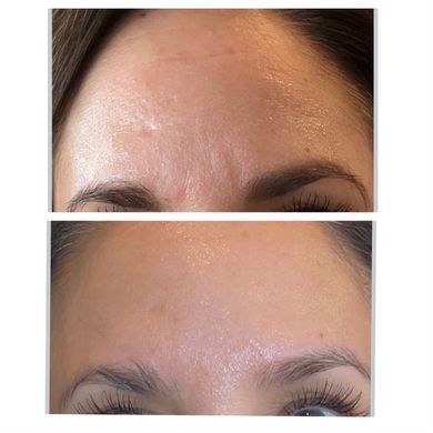 A before and after picture of a woman 's forehead.