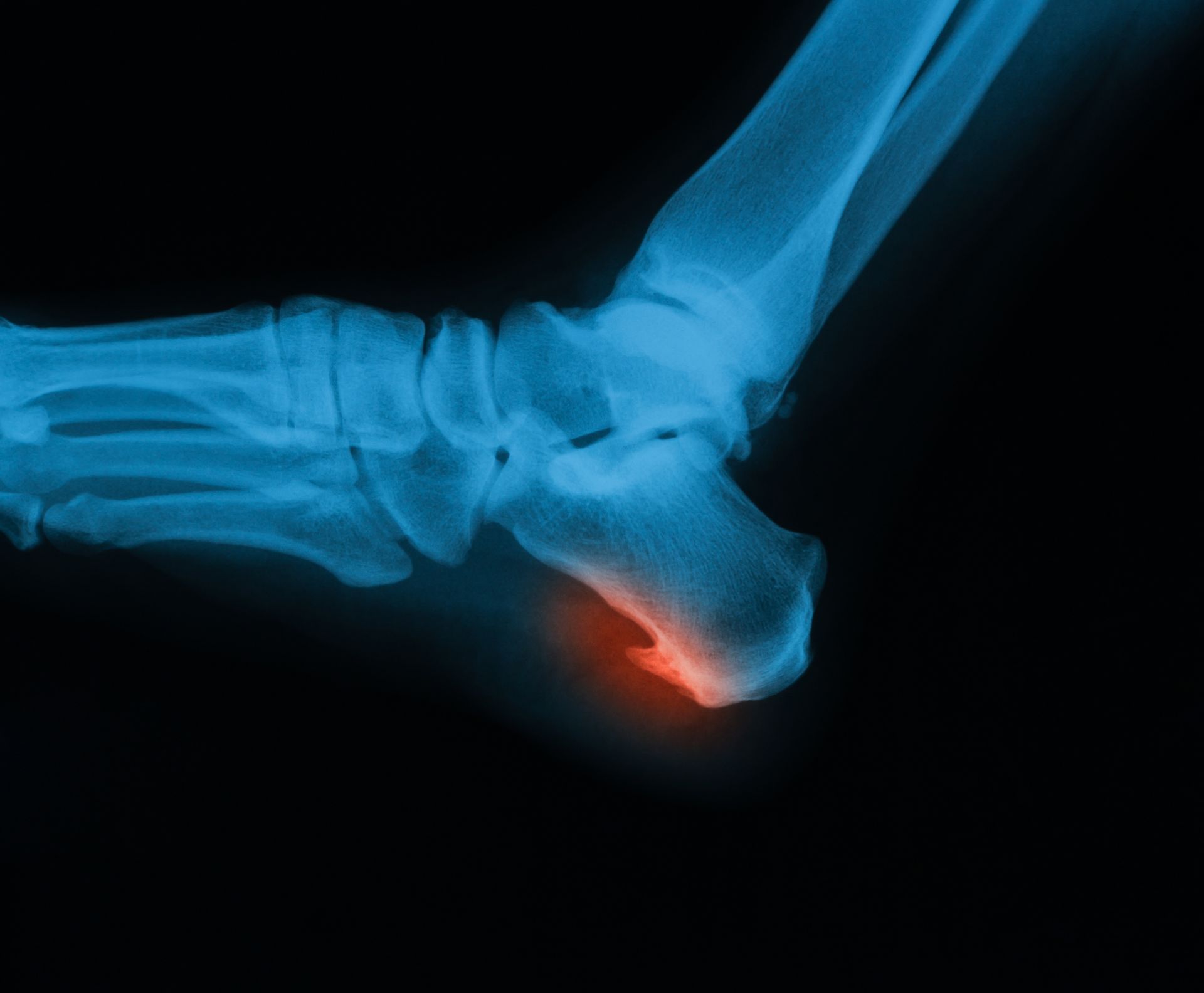 X-ray of foot; the heel is highlighted with red, suggesting injury.