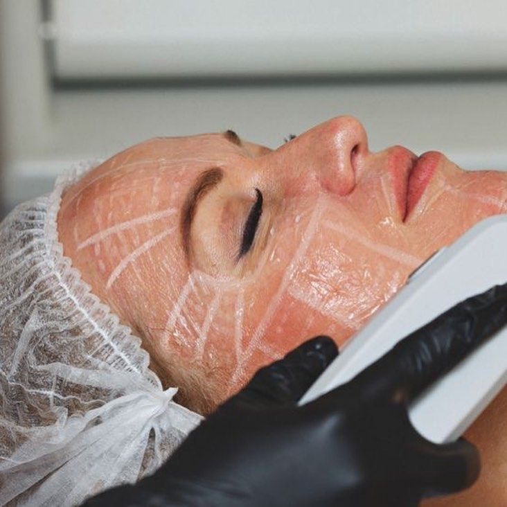 A Woman is Getting a Treatment on Her Face — Aura Mediclinic in Ashmore, QLD