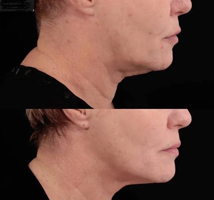 A Before and After Photo of a Woman's Neck and Face — Aura Mediclinic in Southport, QLD