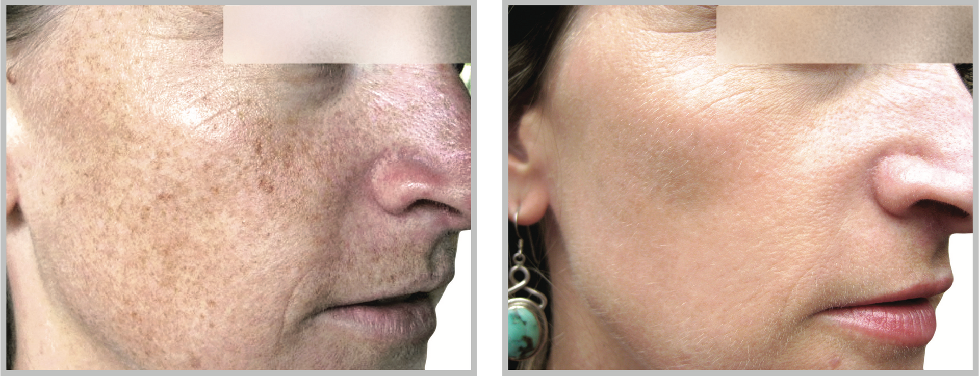 A Before and After Photo of a Woman's Face — Aura Mediclinic in Ashmore, QLD