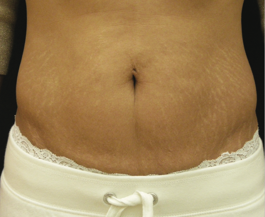 A Close Up Of A Woman's Face Abdoman — Aura Mediclinic In Ashmore, QLD