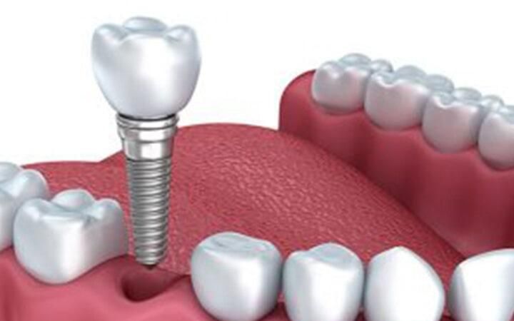 DR. JORGE MARTÍNEZ V – Implantes
