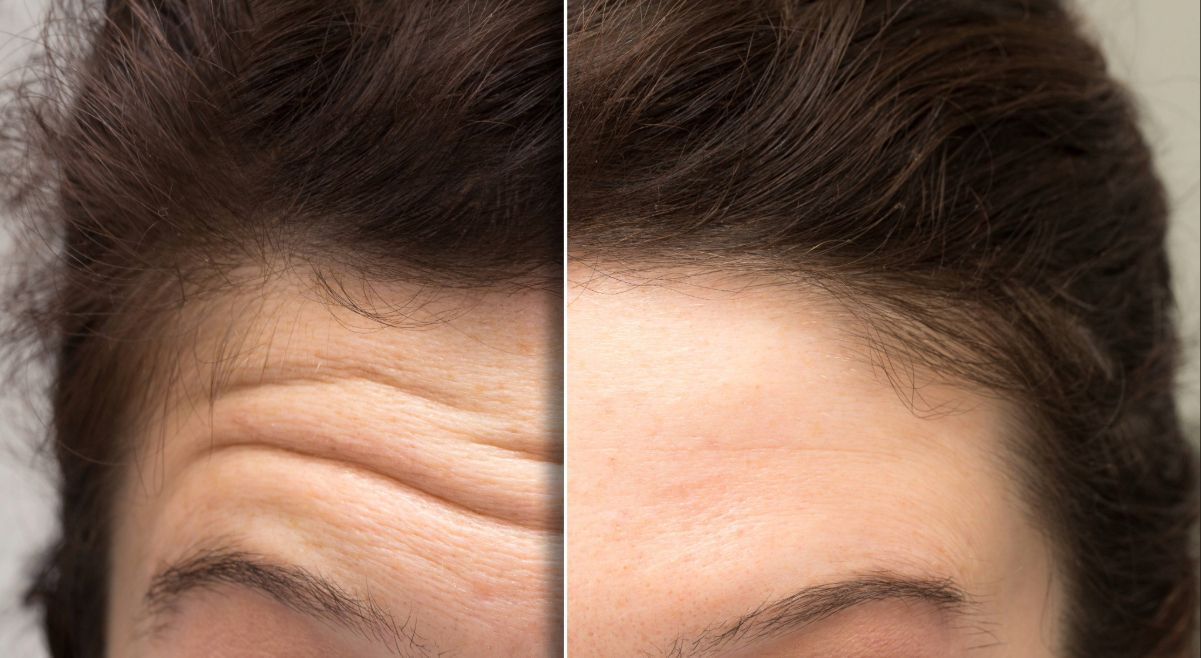 Forehead comparison: Before (wrinkled) and after (smooth) cosmetic treatment.