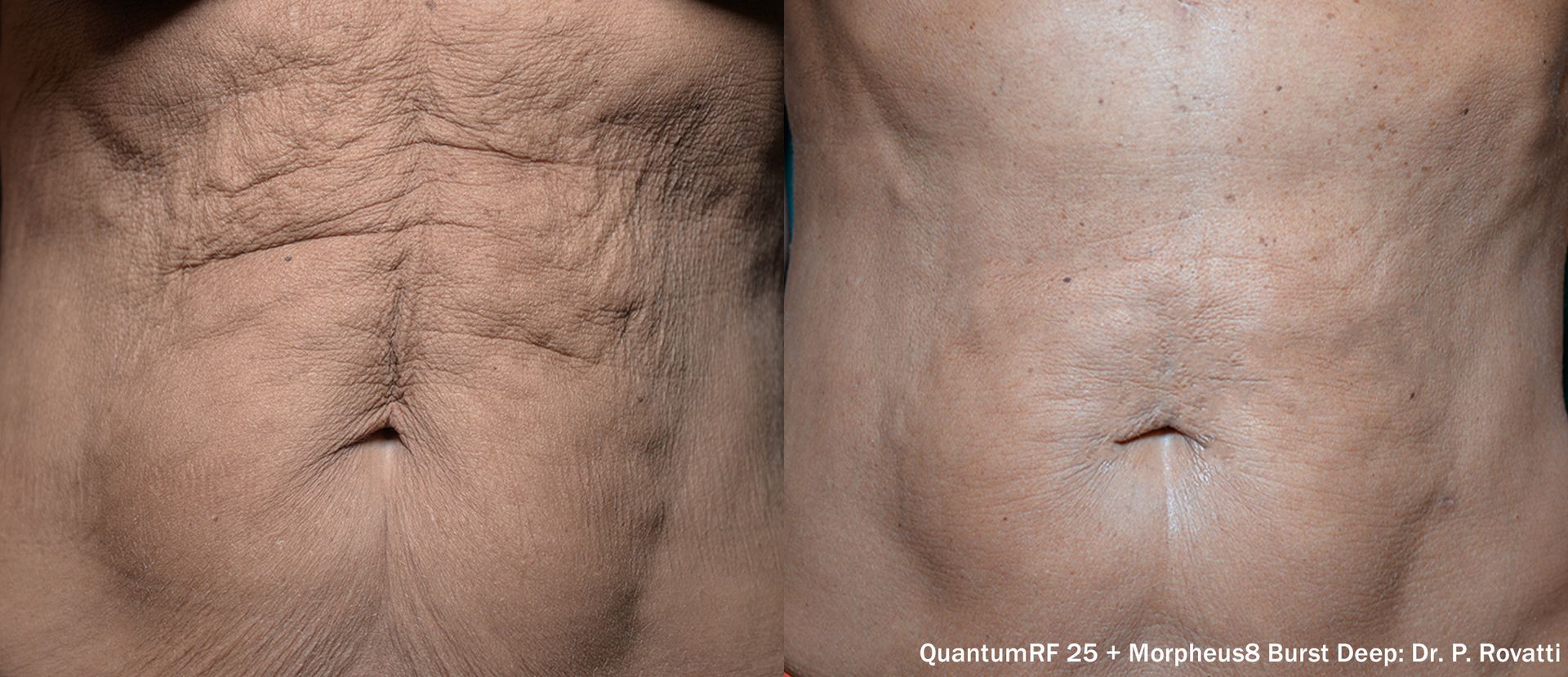 before and after images of a stomach skin