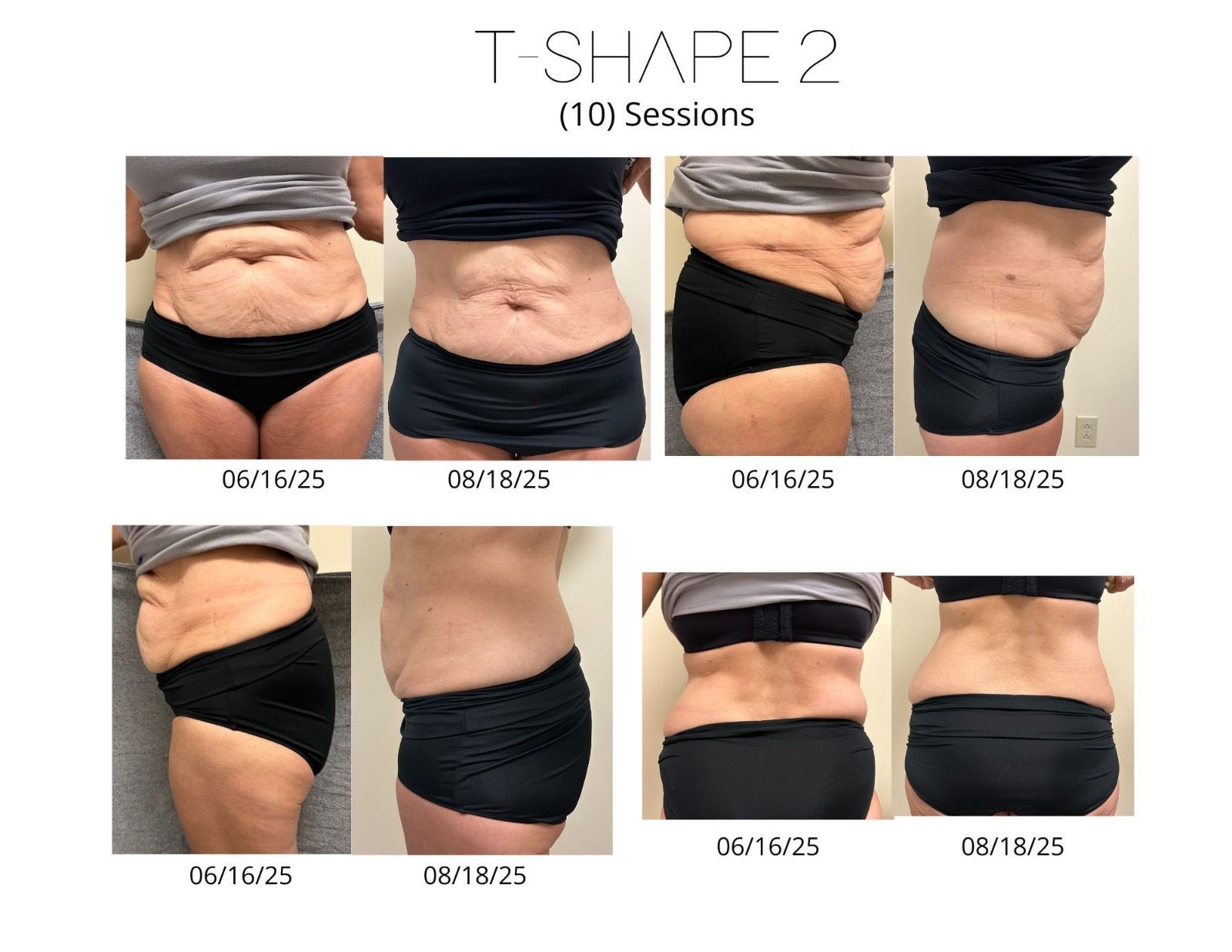 An Artemis T-Shape 2 before and after of a woman's midsection.