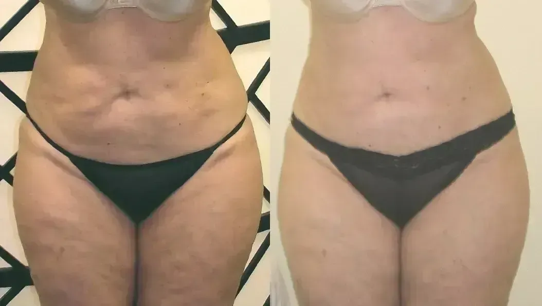 Before and after comparison of a person's abdomen and thighs. Shows reduction in skin dimpling.
