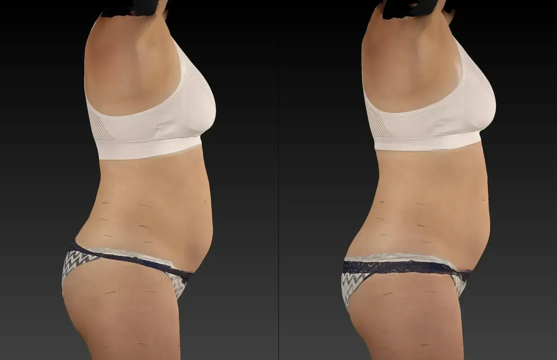 Comparison of a woman's side profile before and after a body contouring procedure, showing abdominal changes.