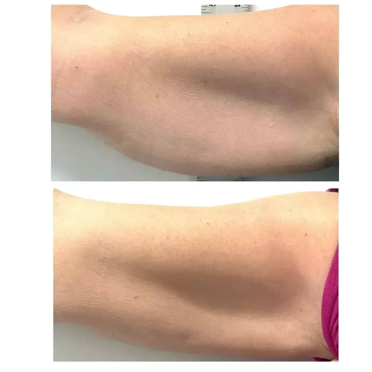 Two views of a human arm. Top view shows speckled skin. Bottom view shows smooth skin, pink wrist.