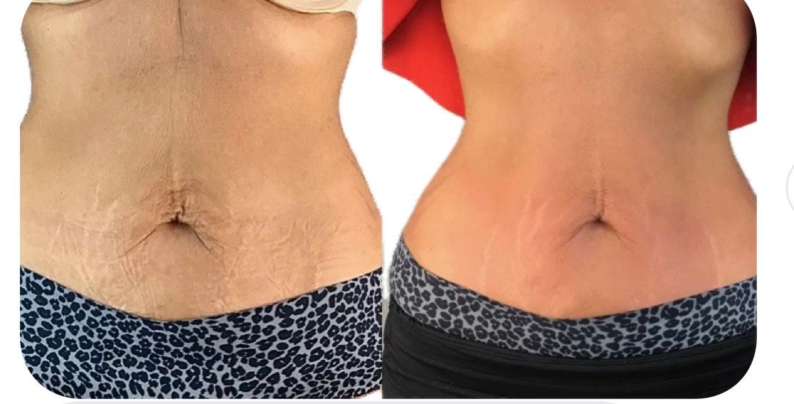 An Artemis T-Shape 2 before and after of a woman's midsection.