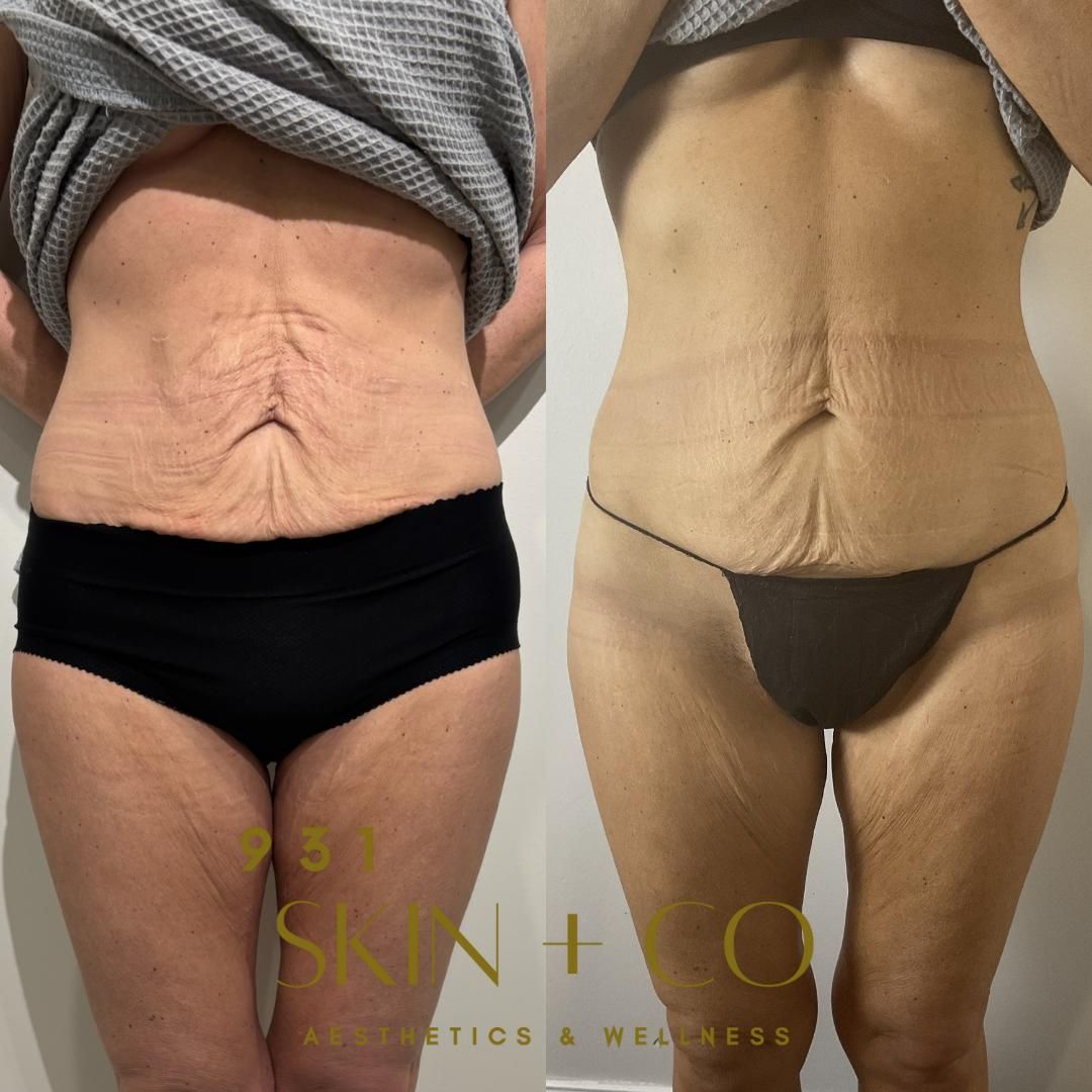 An Artemis T-Shape 2 before and after of a woman's belly and legs.