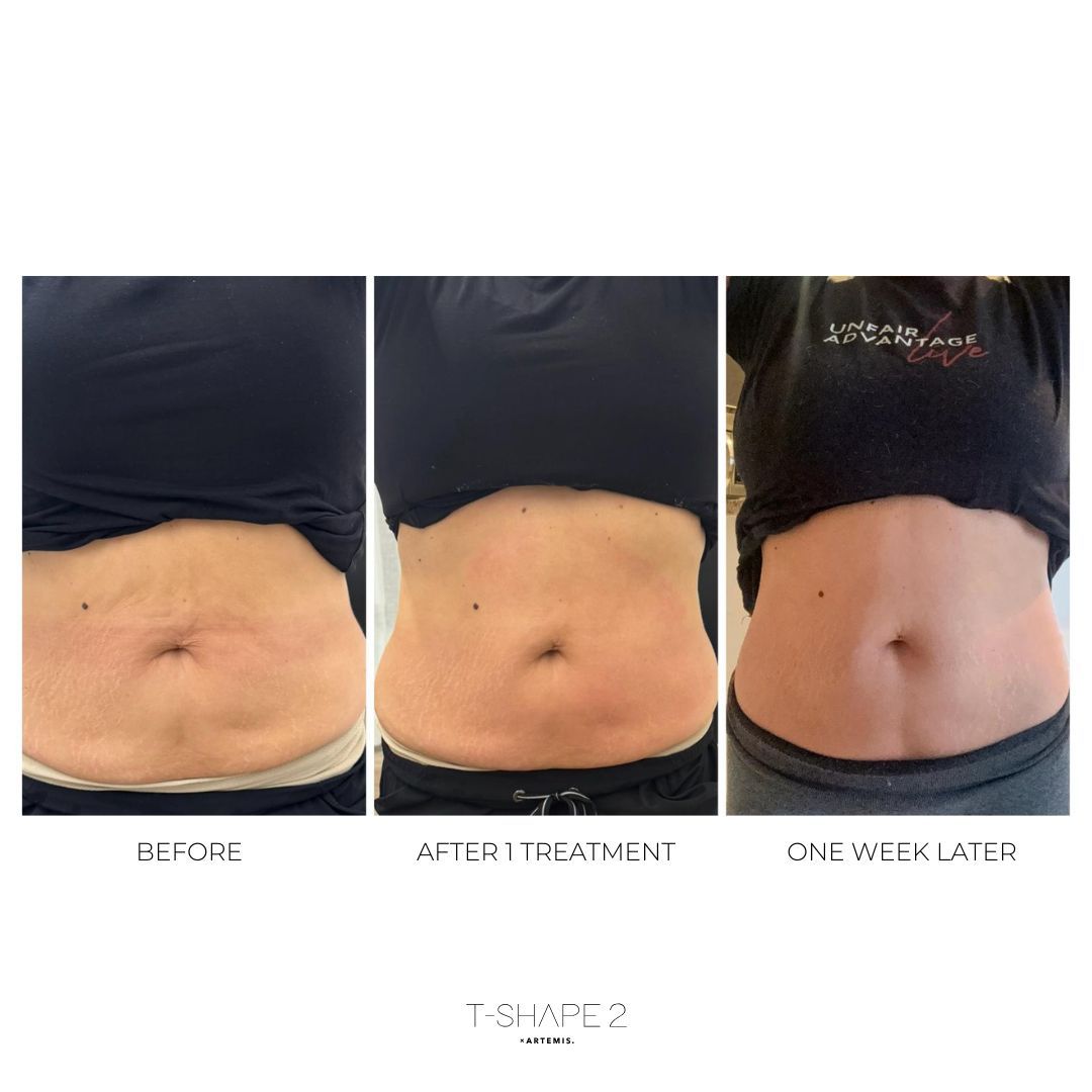 An Artemis T-Shape 2 before and after of a woman's belly.