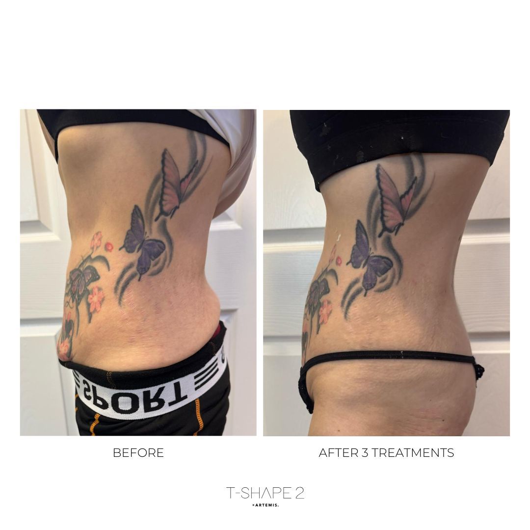 An Artemis T-Shape 2 before and after of a woman's belly.
