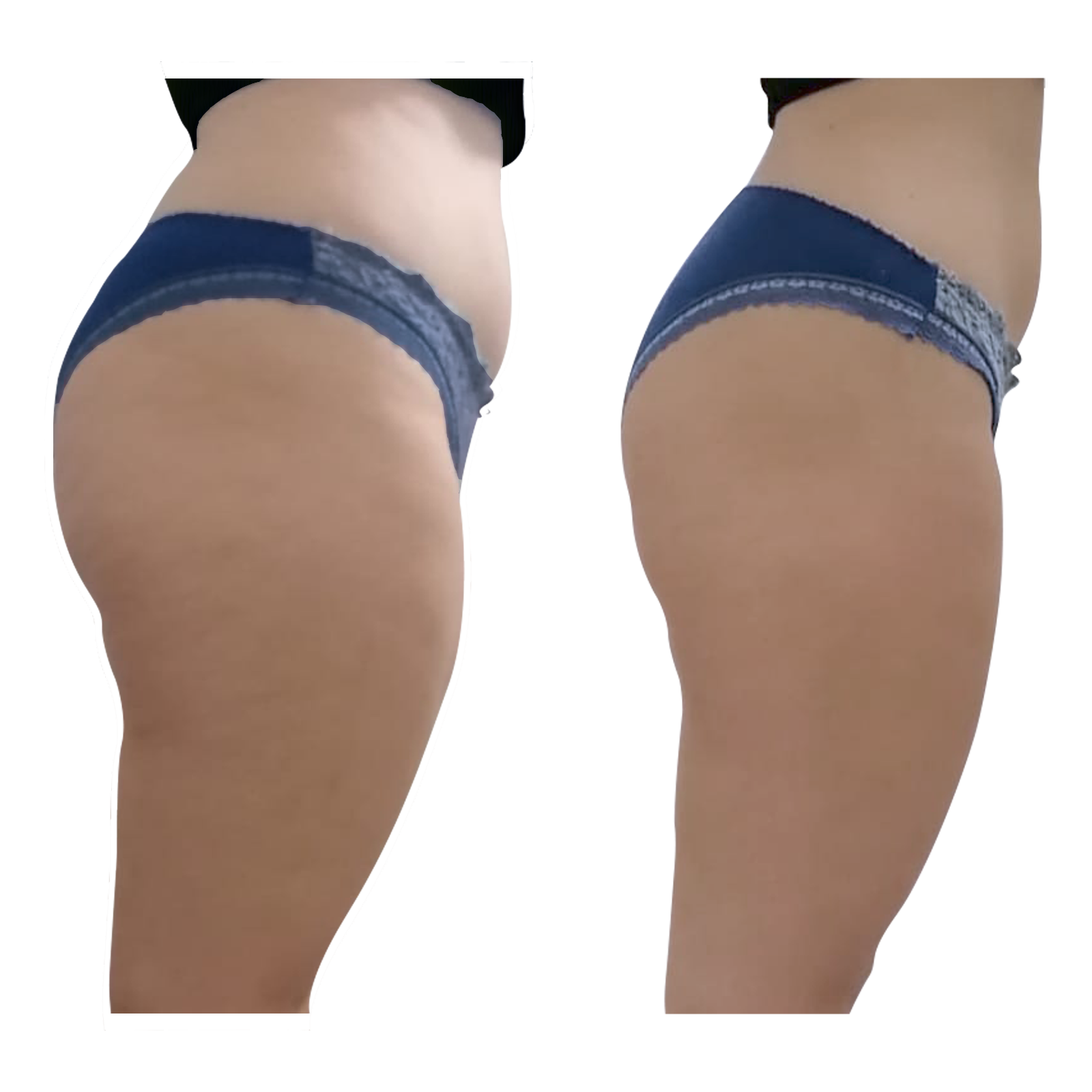 An Artemis T-Shape 2 before and after of a woman's legs.