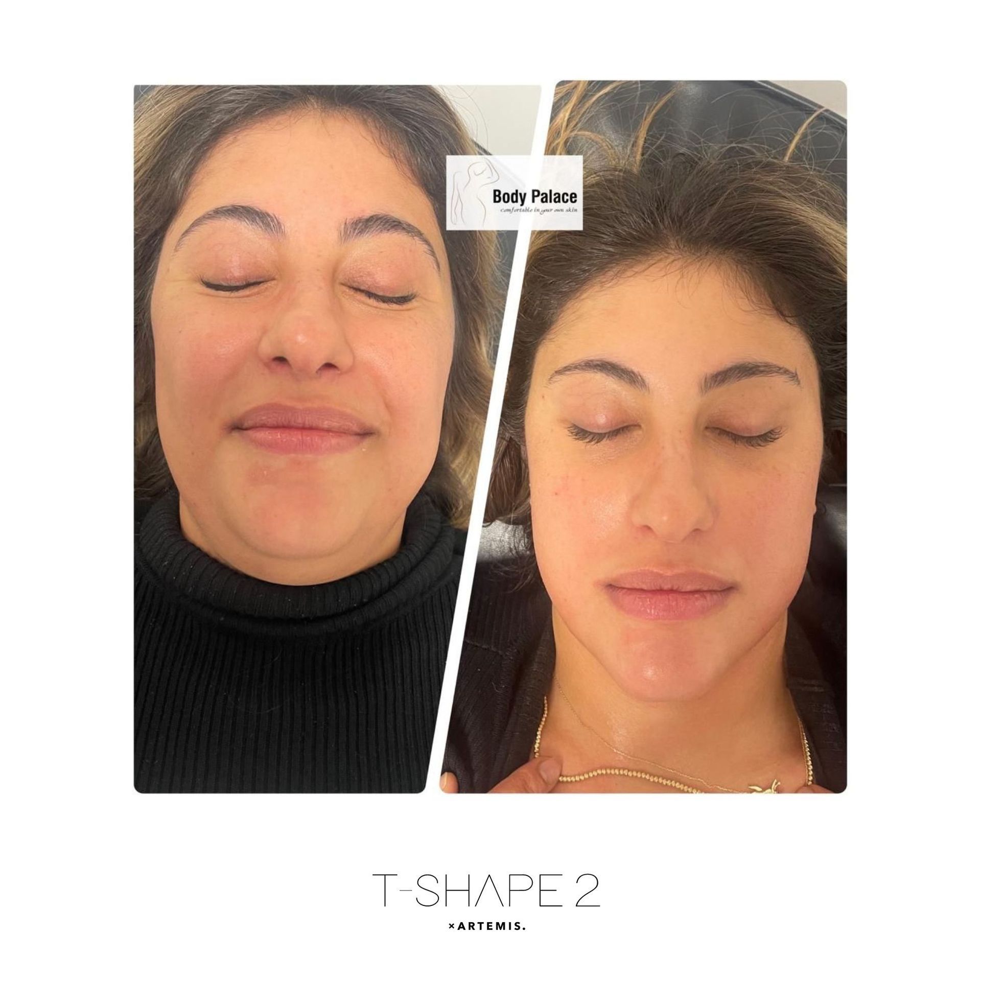 An Artemis T-Shape 2 before and after of a woman's face.