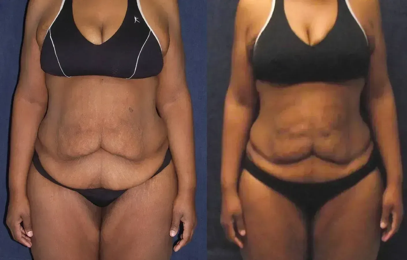 Before-and-after abdominal cosmetic surgery: torso of a person in black undergarments, showing improvement.