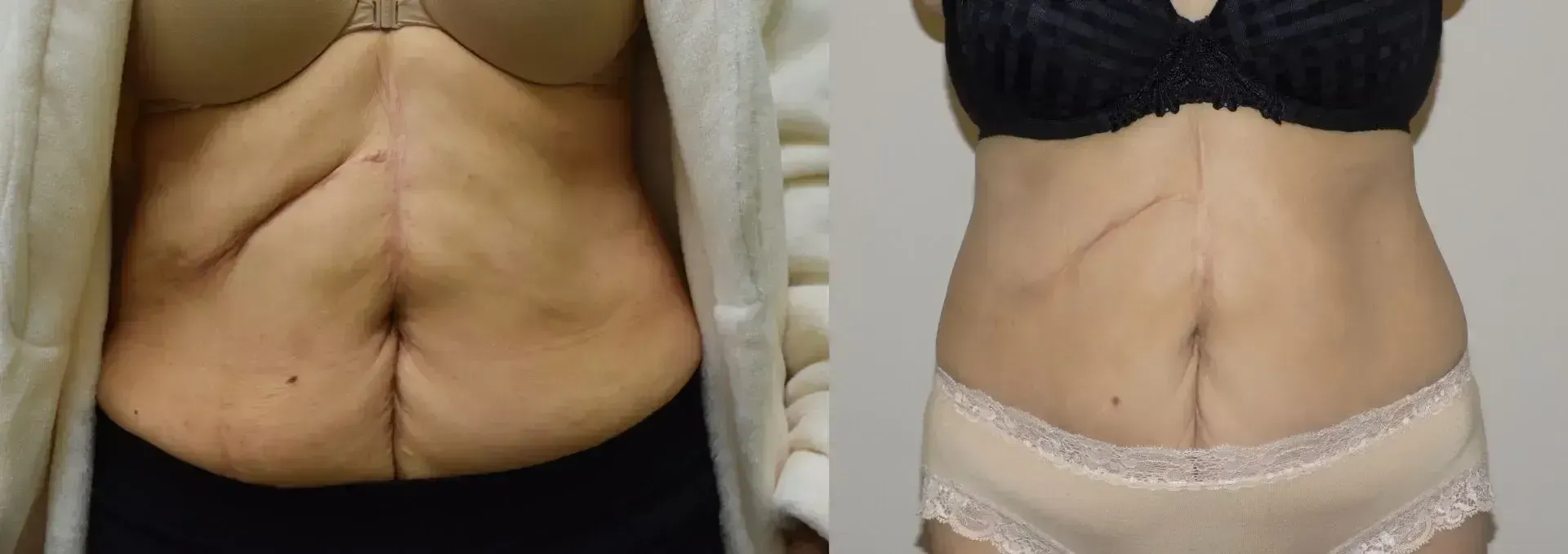 Side-by-side abdominal comparison before and after surgery.