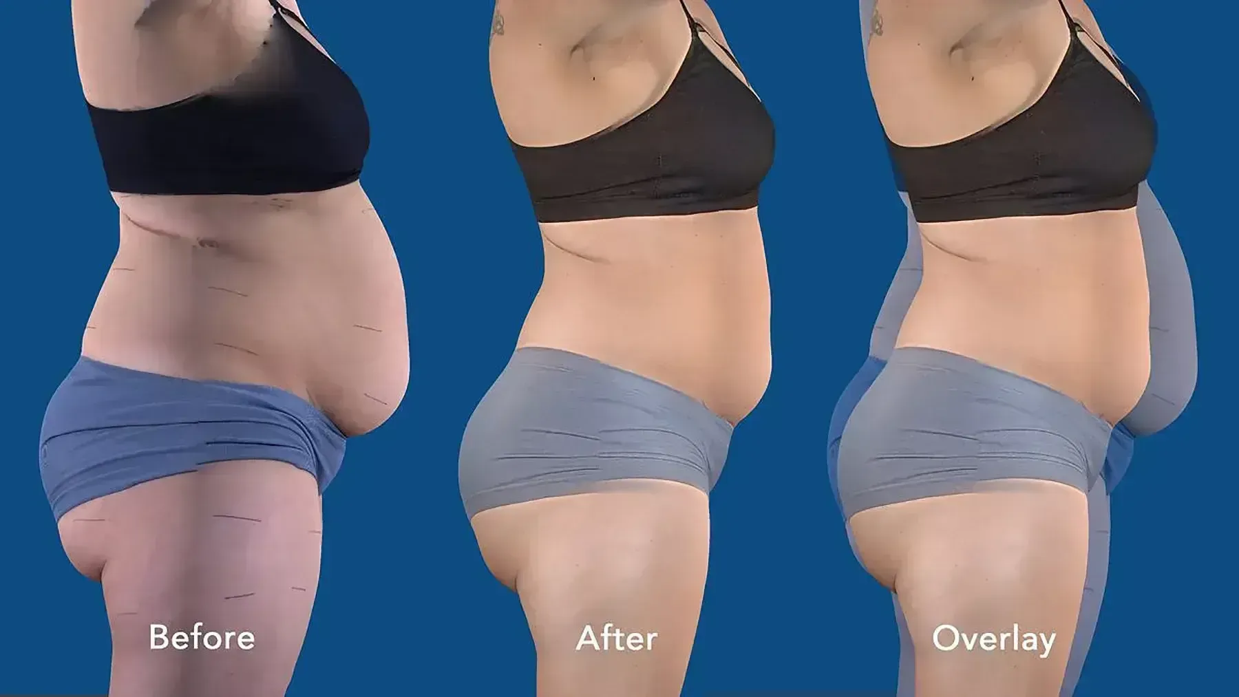 Side-by-side comparison: before, after, and overlay of a person's torso, demonstrating weight loss from stomach.