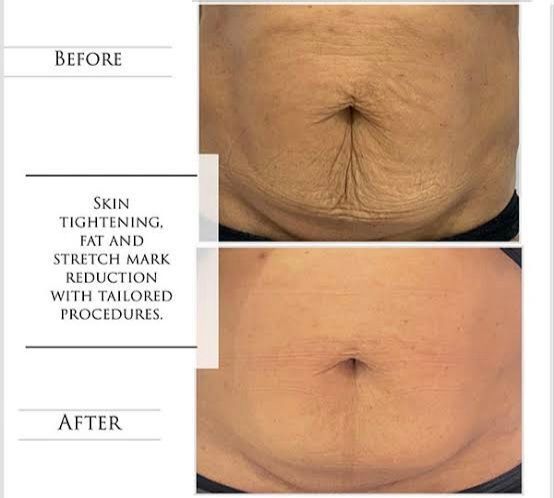 An Artemis T-Shape 2 before and after of a woman's belly.