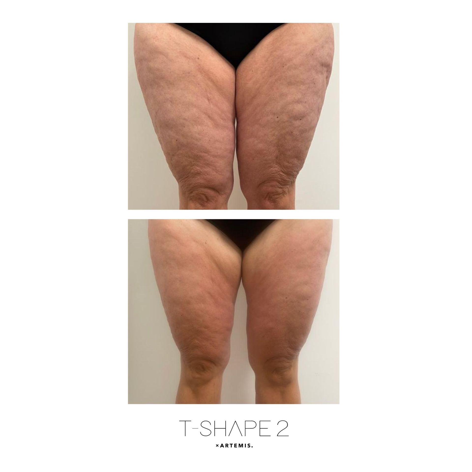 An Artemis T-Shape 2 before and after photo of a woman's legs.