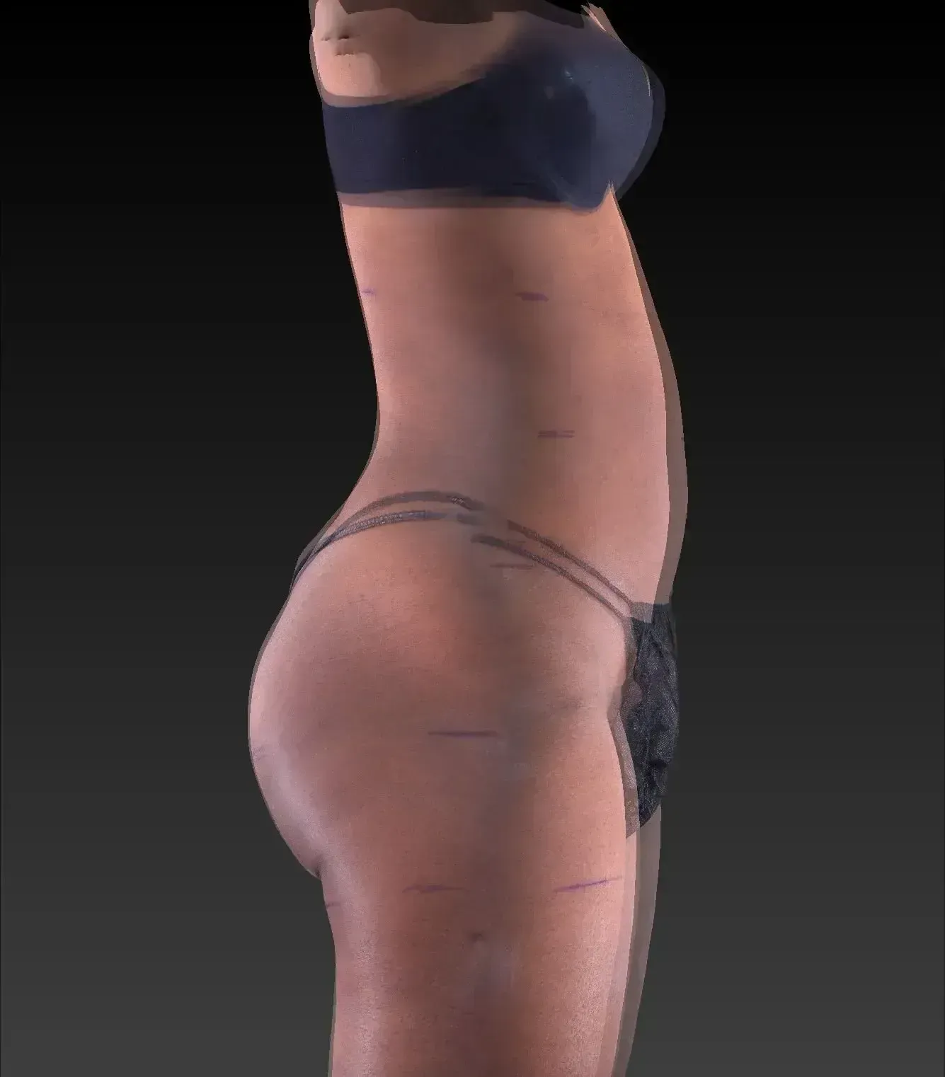 Side view of a person in lingerie; markings on skin are visible.