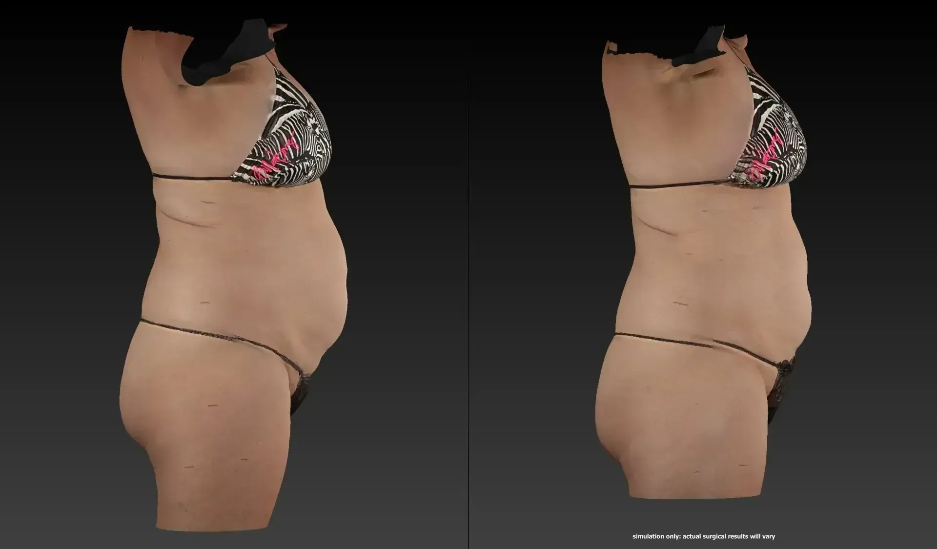 Two side-view torsos in bikinis; the left one appears fuller in the midsection compared to the right.