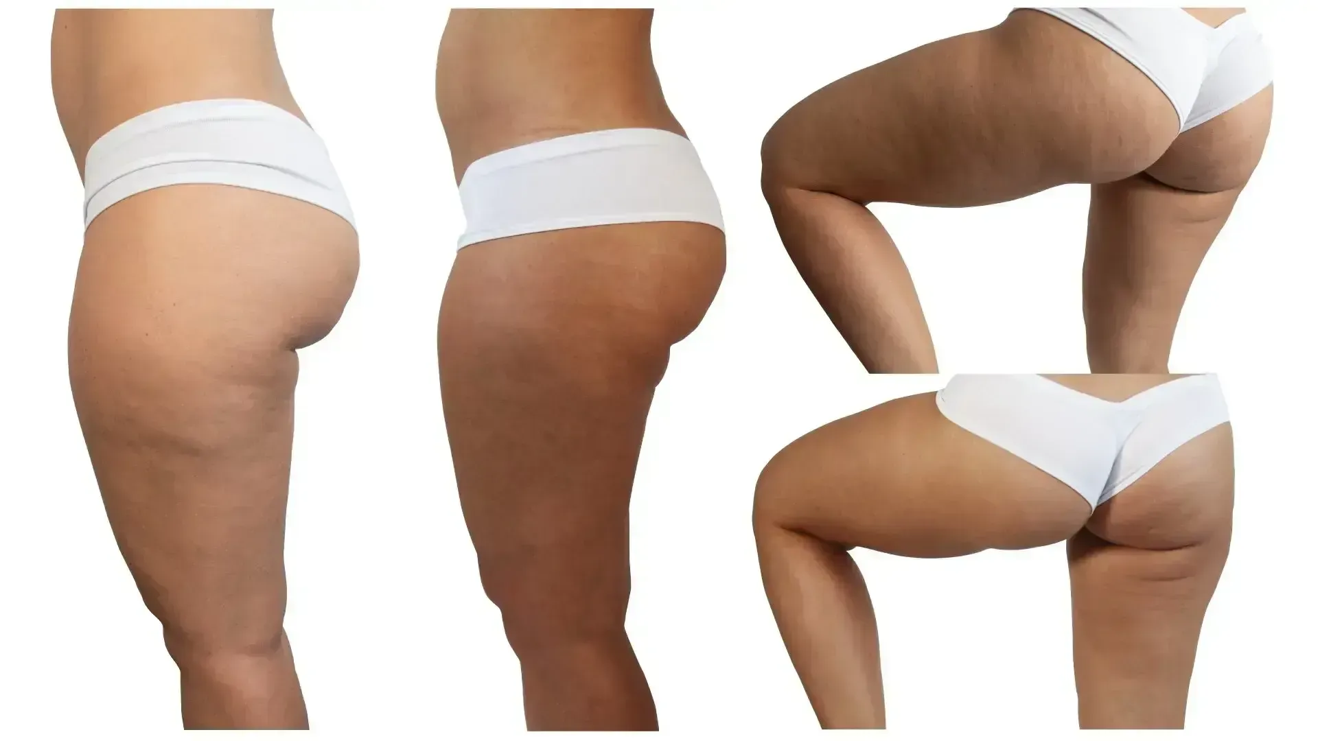 Multiple views of a person's legs and buttocks, showing visible cellulite while wearing white underwear.