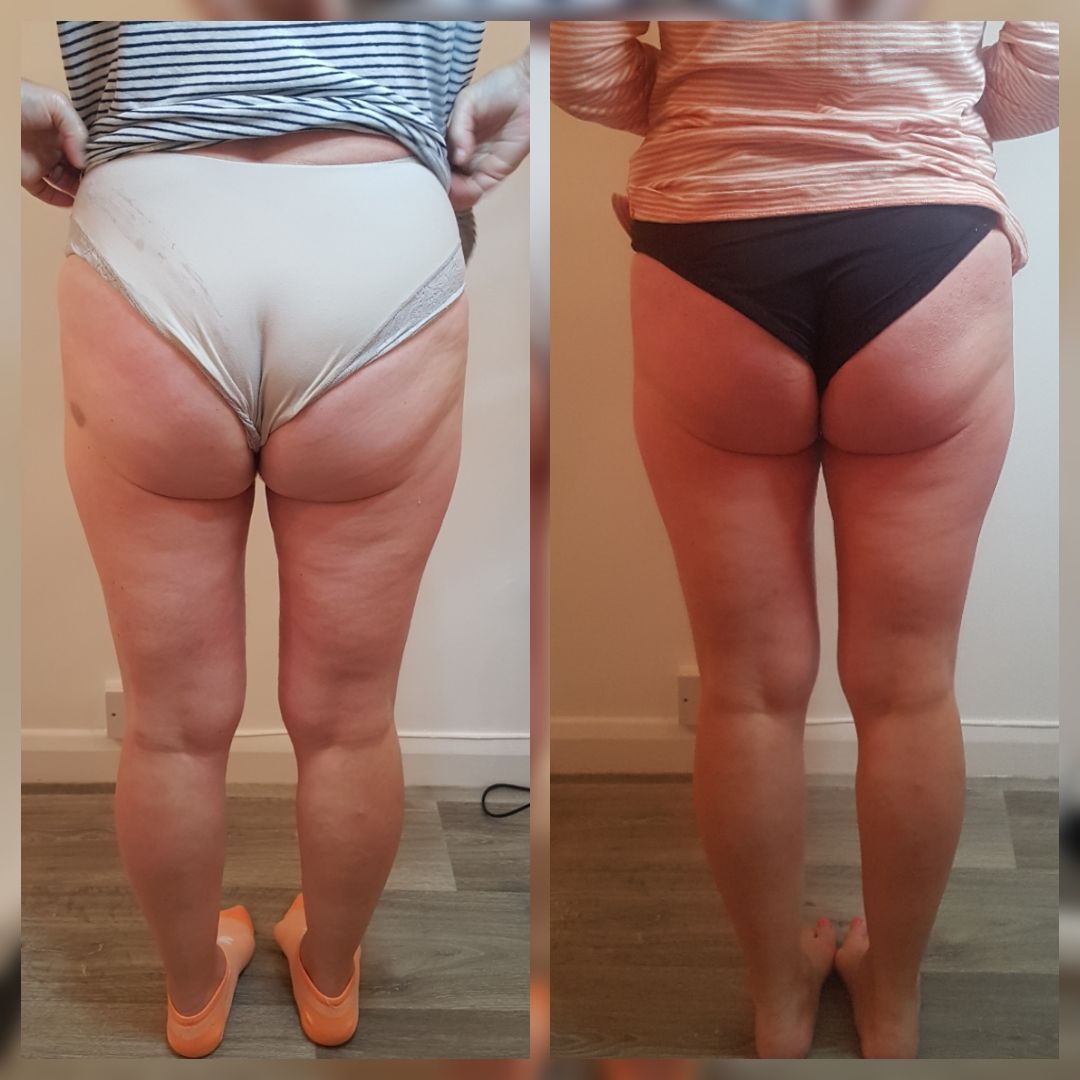 An Artemis T-Shape 2 before and after of a woman's glutes and legs.