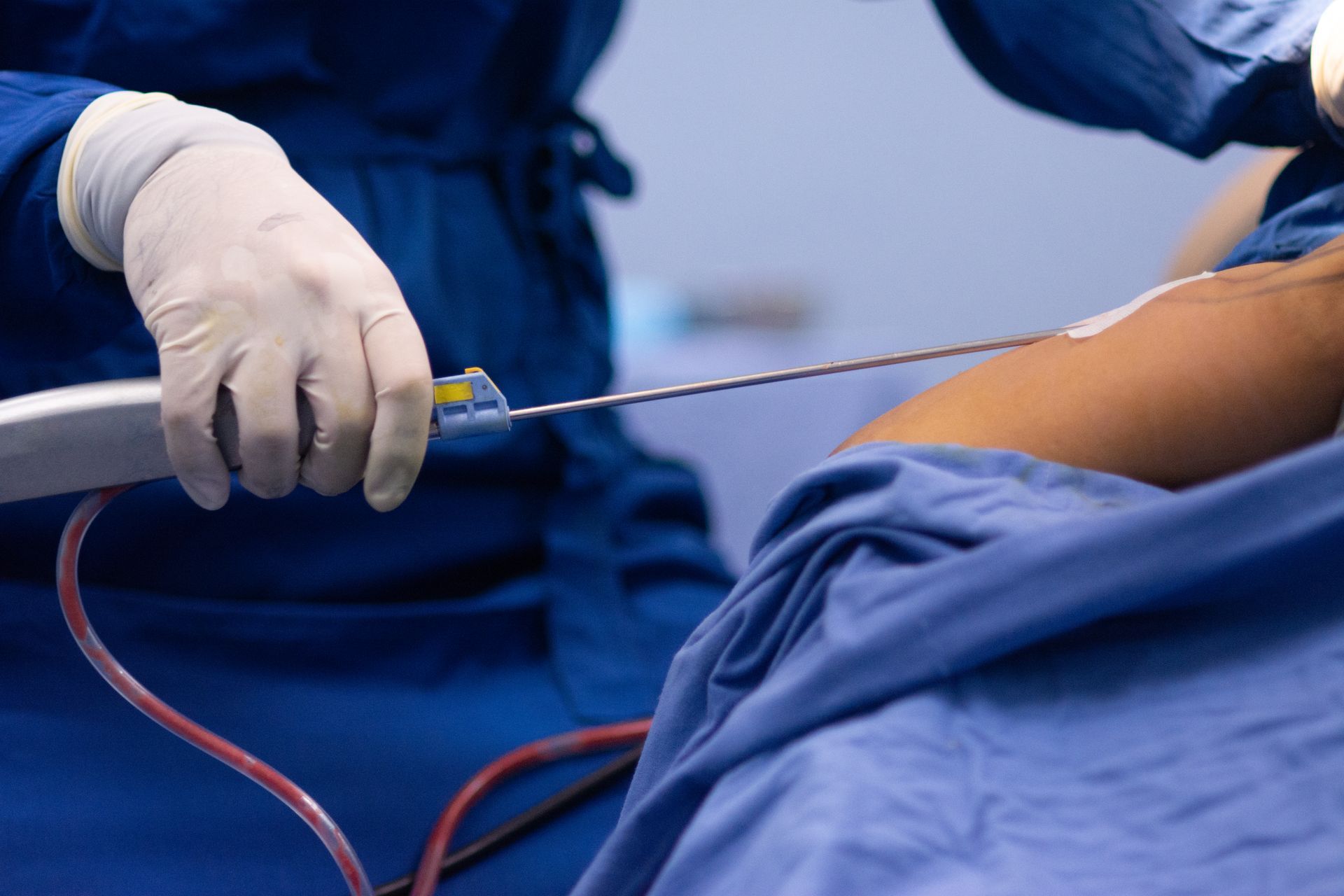Surgeon using a liposuction device on a patient's arm during a procedure; blue drapes and gloves.