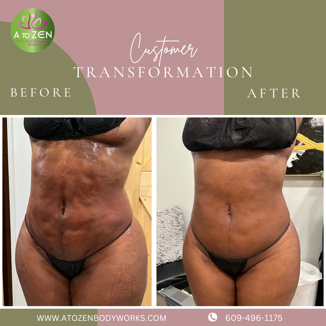 Before-and-after torso photos showing a slimmer abdomen and waist transformation.