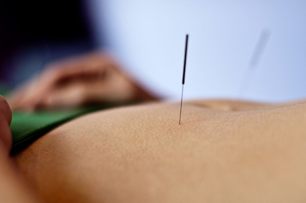 A person is getting acupuncture on their back.