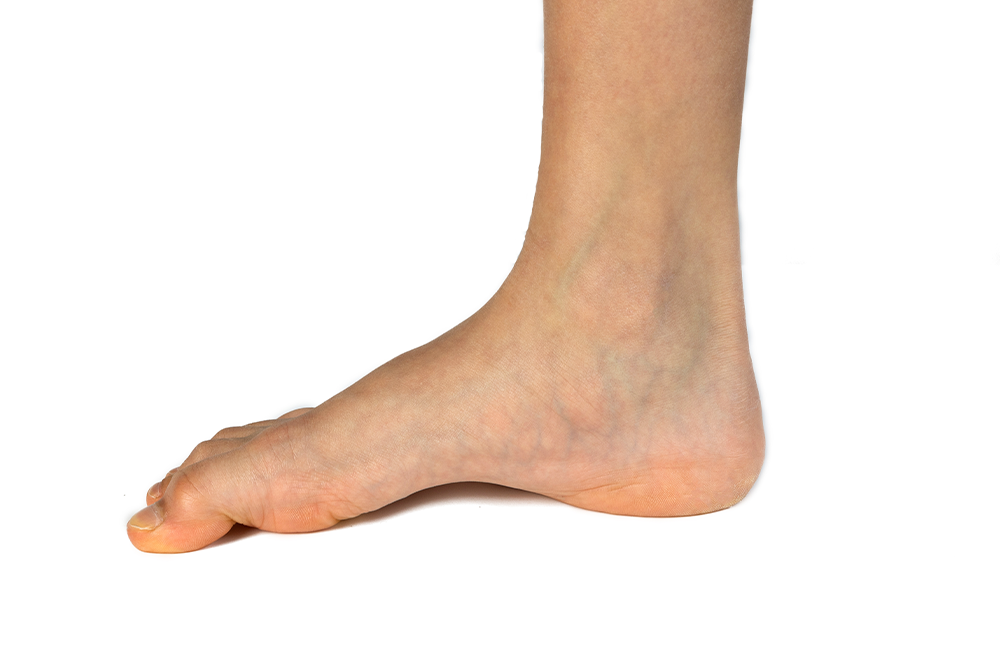 High Arched Feet