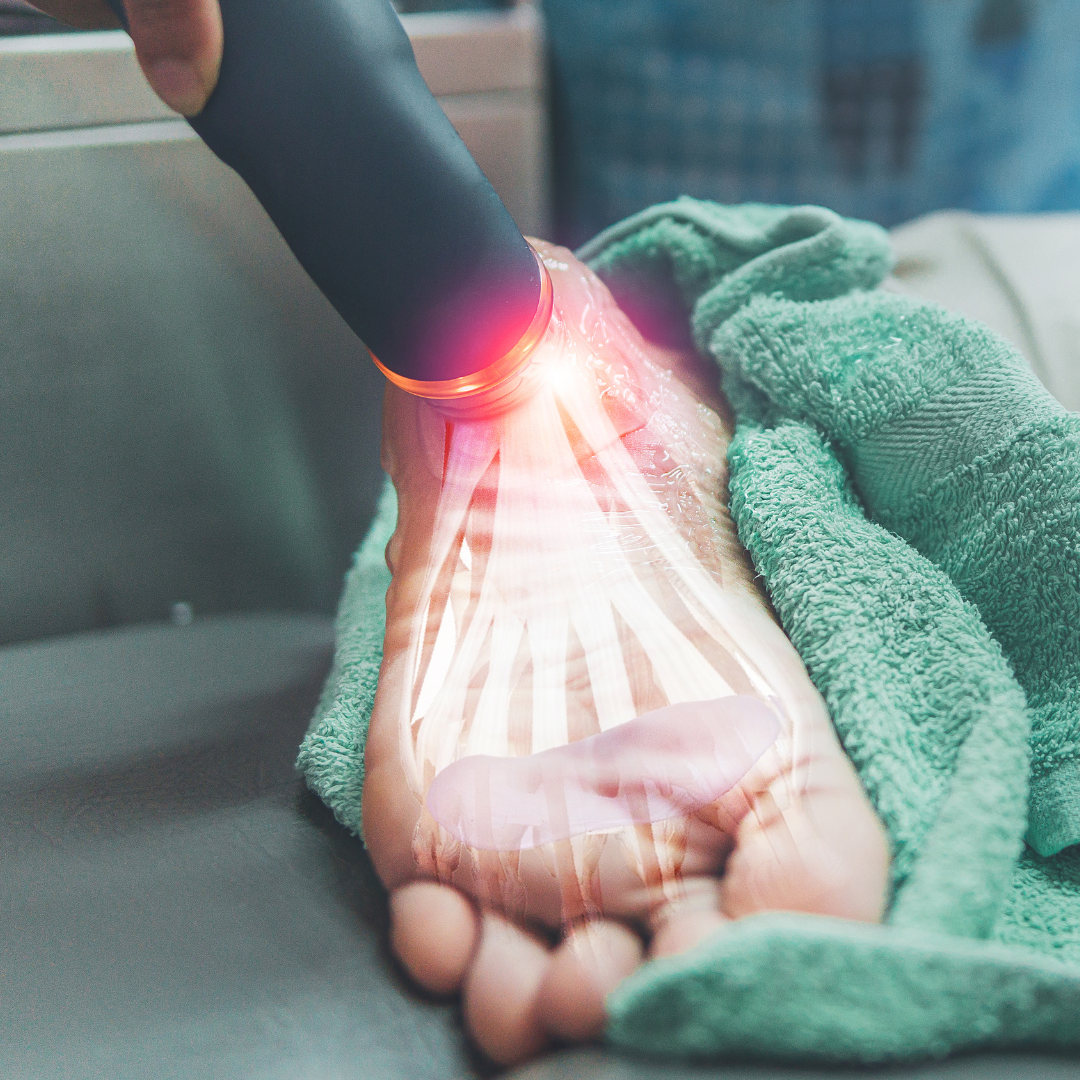 Plantar Fasciitis