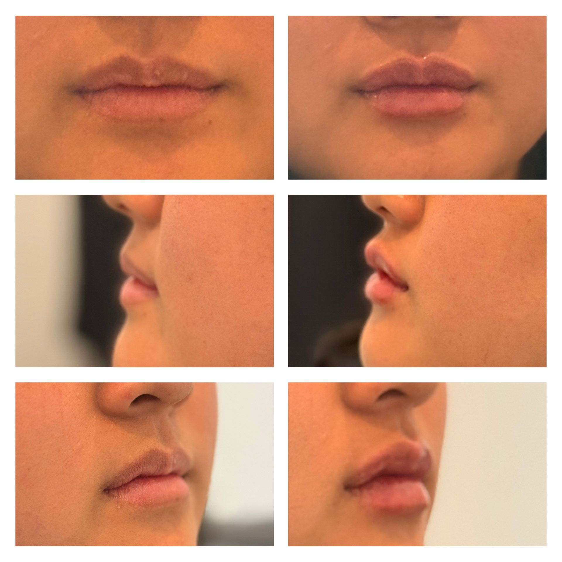 Six photos showing a person's lips before and after a lip augmentation procedure.